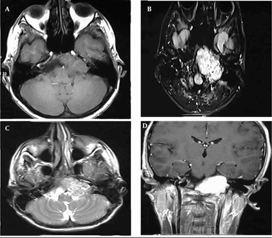 Skull Base Aneurysmal Bone Cyst Presented with Foramen Jugular Syndrome {faces}